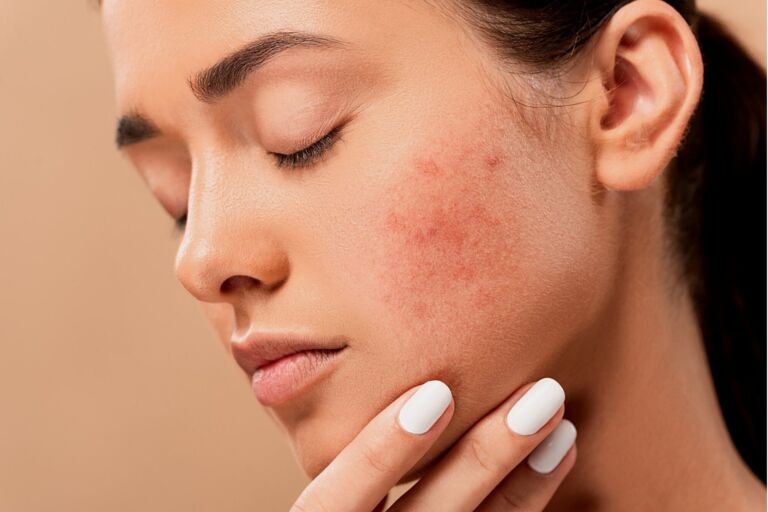 5 consejos para prevenir y tratar el acné en la piel por usar el tapabocas
