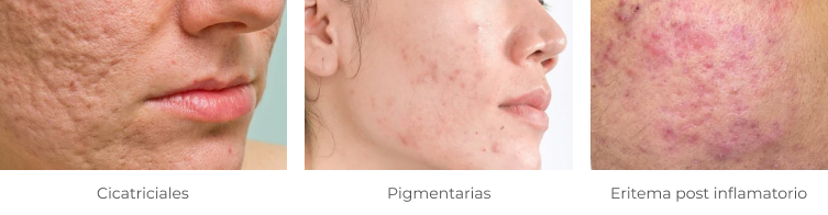 Tipos de Manchas por secuelas del acne